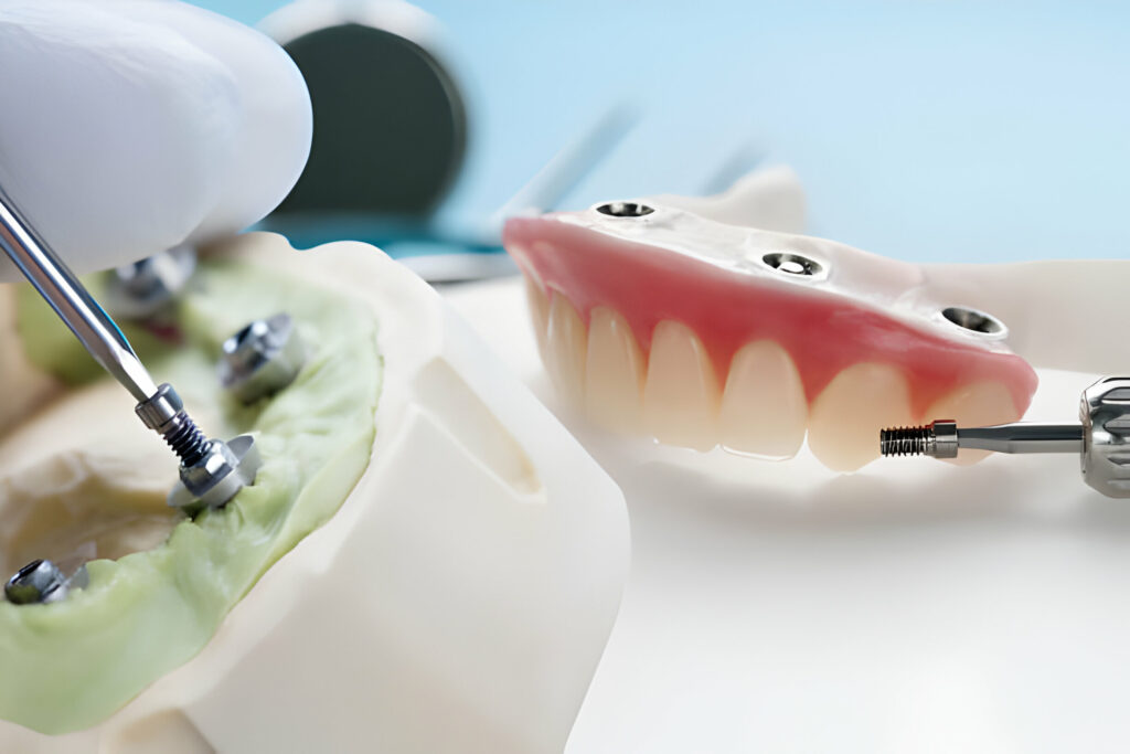 Dental Implants Vs. Dentures: How to Make The Right Choice_1
