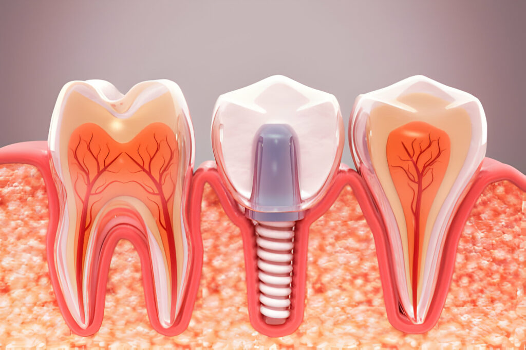 Dental Implants Vs. Dentures: How to Make The Right Choice_2