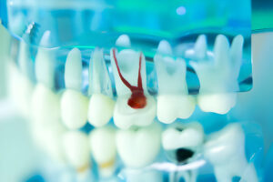 The Complete Guide to Tooth Extraction: What to Expect Before, During, and After_FI