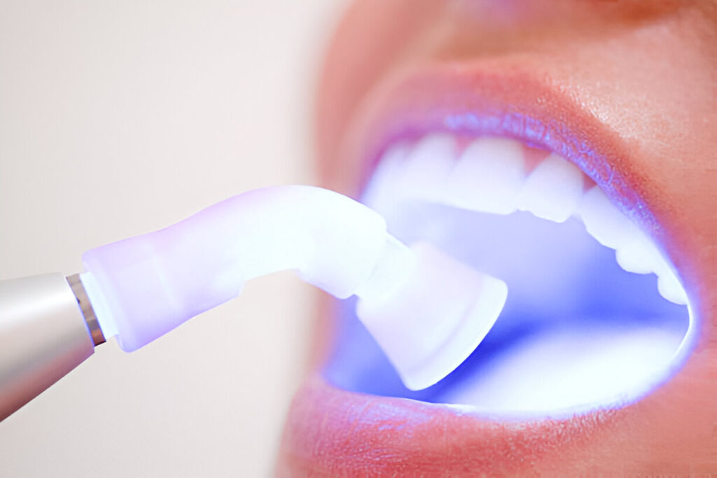 Safe Teeth Whitening: Why Professional Treatments Are the Best Choice_2