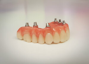 What to Expect When Getting Partial Dentures at Distinctive Dental Concepts in Garland, TX_FI